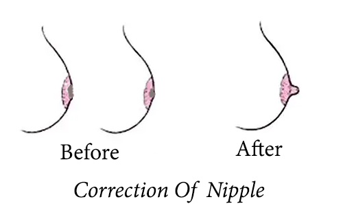 Inverted Nipple Correction near me by Dr Amiti Shah